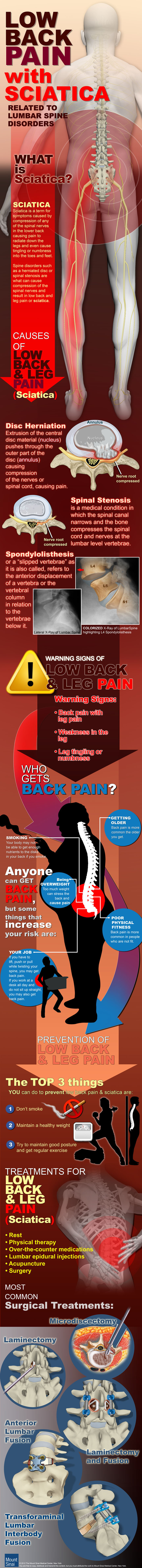 Low Back Pain with Sciatica