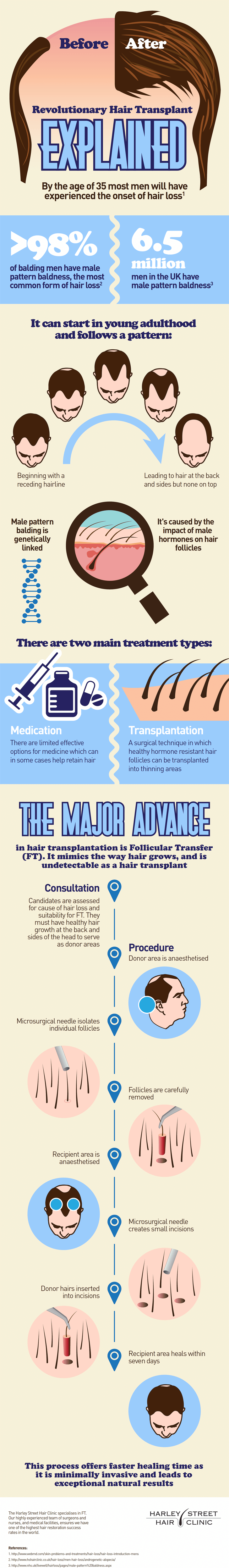 What Is Follicular Transfer?