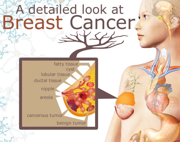 A Detailed Look at Breast Cancer