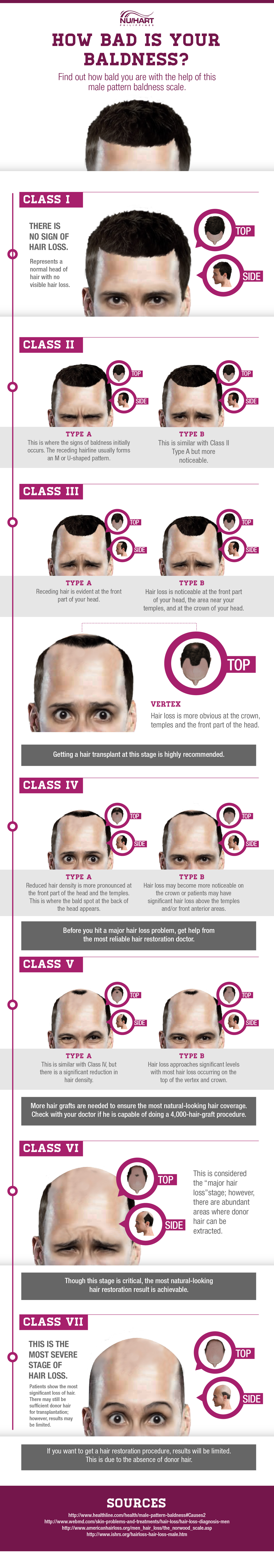 Male Baldness Scale: How Bad is Your Bald?