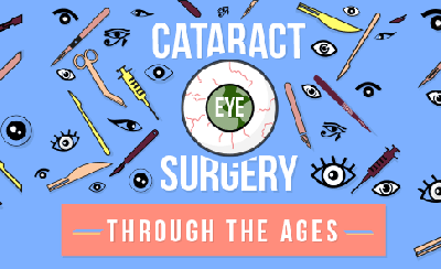 History of Cataract Surgery