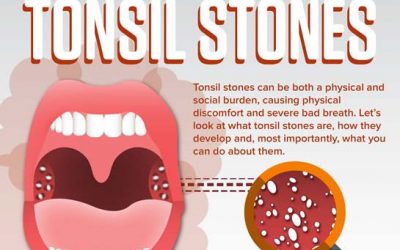 The Hard Facts About Tonsil Stones