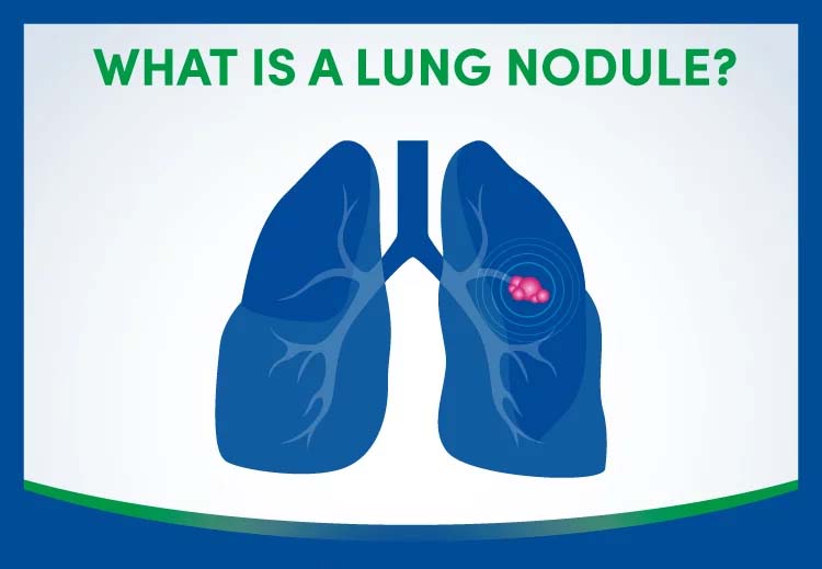Pulmonary Nodule Size