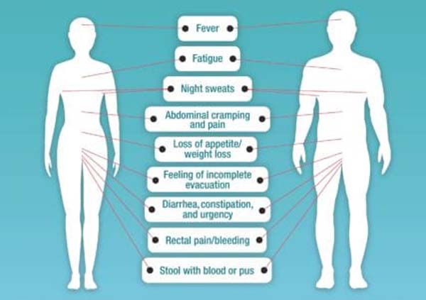 Ulcerative Colitis: Find Relief for Your Symptoms