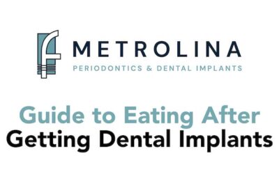 Guide to Eating After Getting Dental Implants